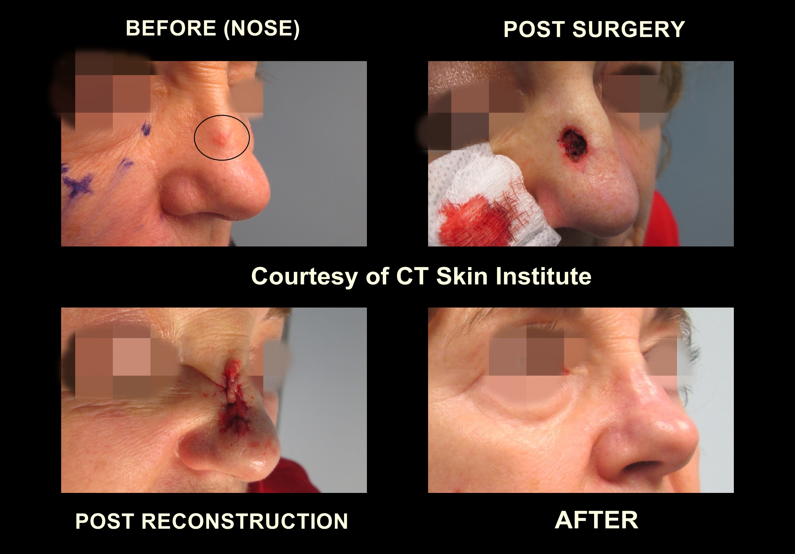 Skin Cancer Pictures Before And After Basal Cell Surgery with Mohs