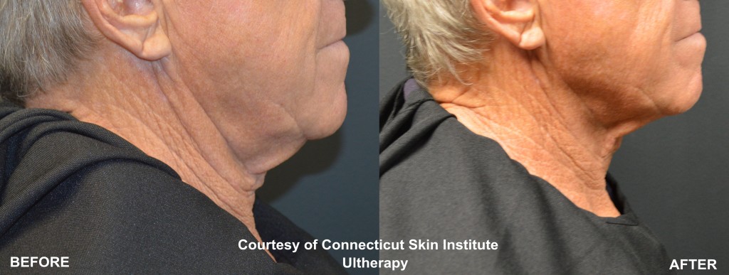 Ultherapy.skin.tightening.jowls.male.stamford.ct.dermatologist