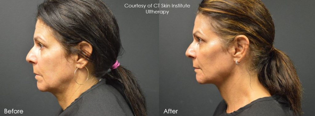 ultherapy, before, after, photo,expert, skin, tightening, stamford, darien, new canaan, ct