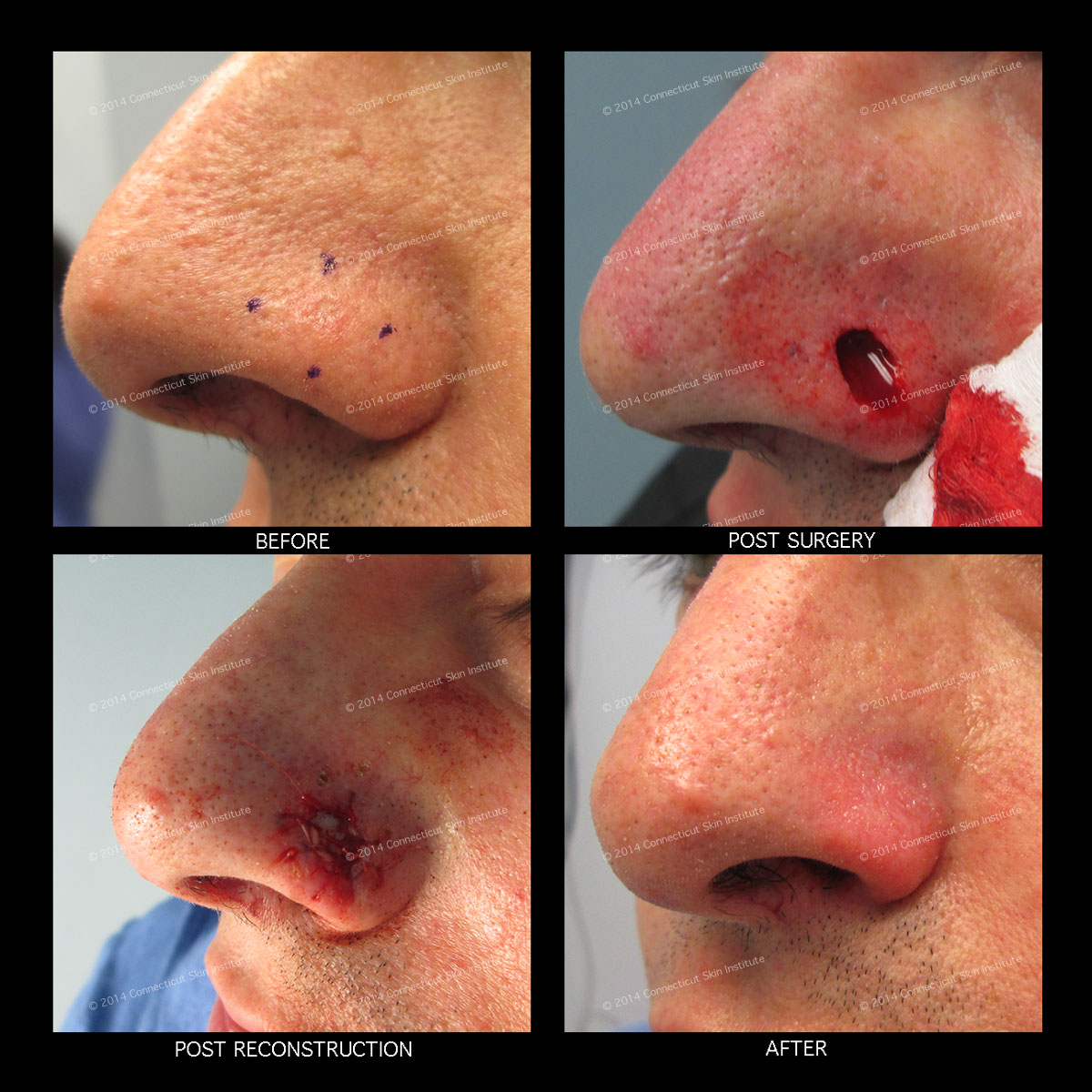 Mohs and Reconstructive Surgery - Left Nasal II ...