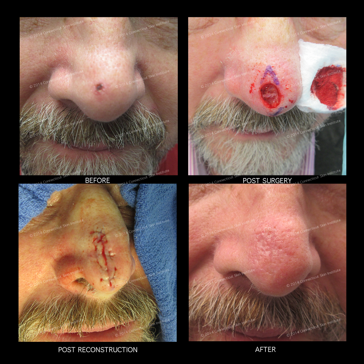 mohs and reconstructive surgery nose connecticut skin mohs and reconstructive surgery nose connecticut skin
