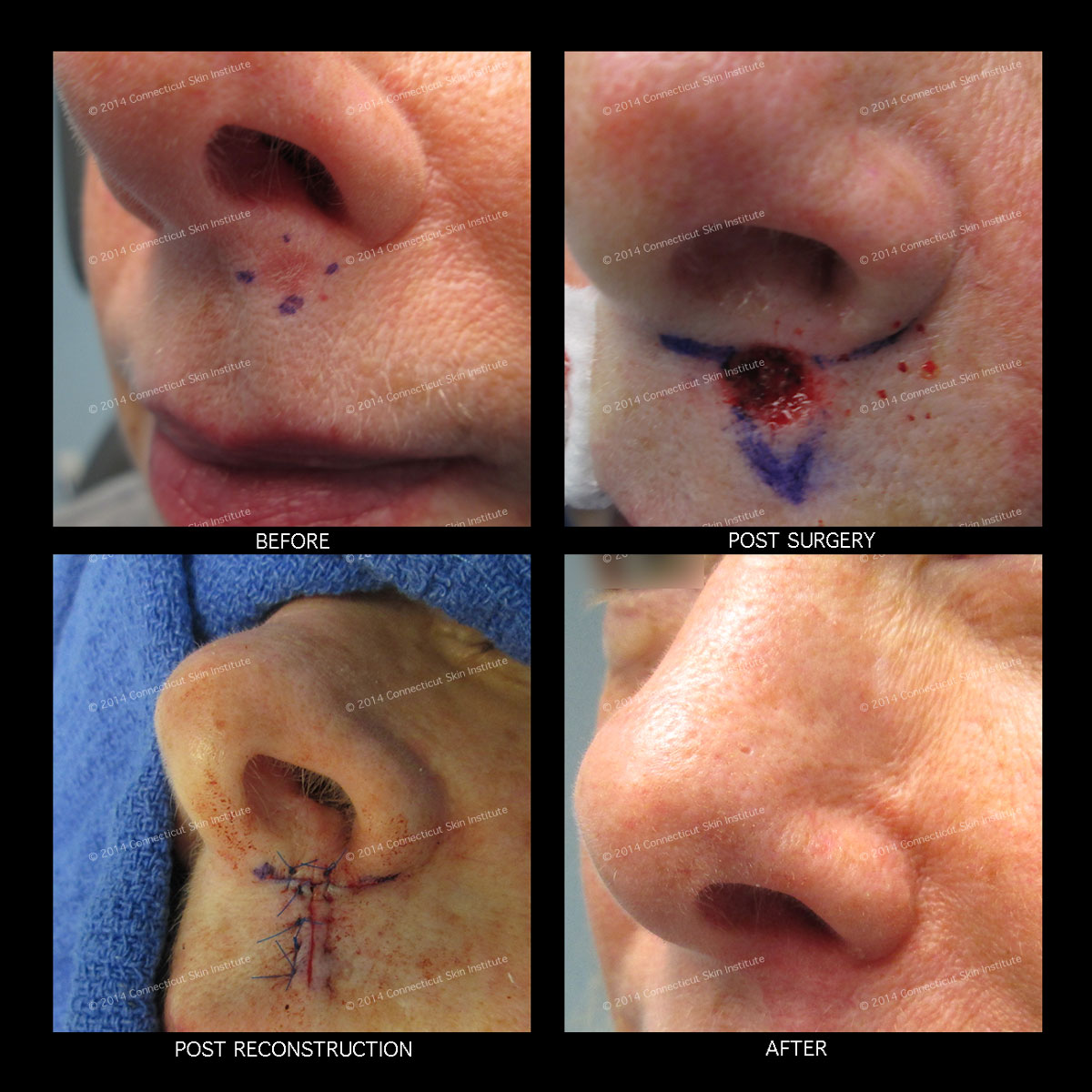 Mohs and Reconstructive Surgery - Upper Lip - Connecticut ...