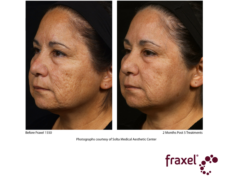 Fraxel Laser Acne Scars and Photoaging