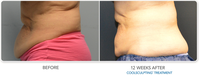 coolsculpting, female, stomach, freezethefat, coolsculptingstamford, coolsculptinggreenwich