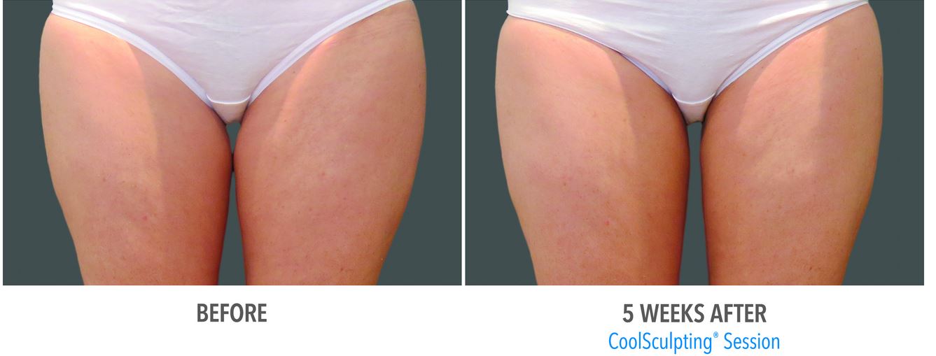Coolsculpting-Inner-Thigh-Stamford-CT