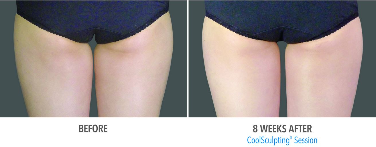 Coolsculpting-Inner Thigh-Stamford-CT