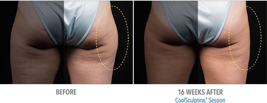 CoolSmooth Pro-Coolsculpting-Stamford-CT