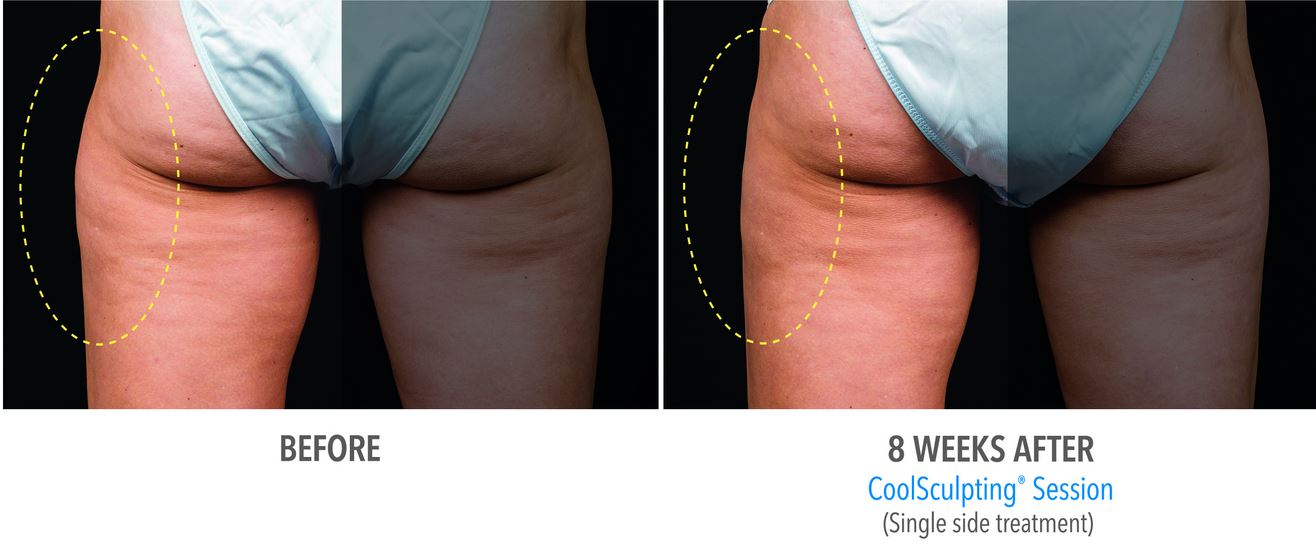 CoolSmooth-Coolsculpting-Outer-Thigh-Freeze-Fat-Stamford