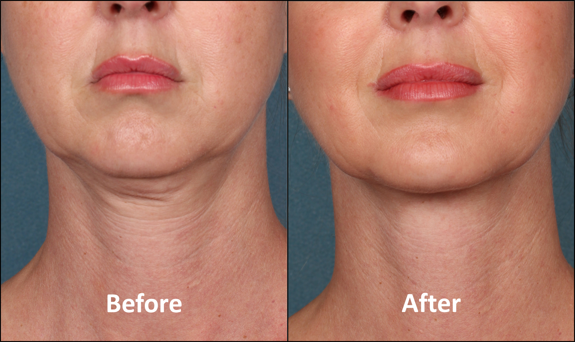 Kybella: double chin fat reduction - Connecticut Skin ...