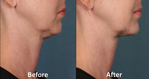 Kybella-double chin reduction-double chin-before-after-picture-submental fat-stamford-greenwich-new canaan-darien