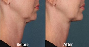 Kybella.before.after_.stamford.ct_