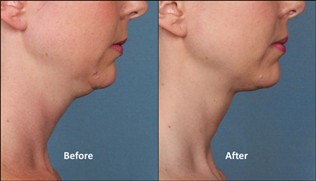 female_kybella_kythera_allergan_double chin_stamford_ct_dermatologist_side