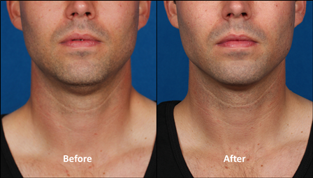 kybella_kythera_allergan_double chin_stamford_ct_dermatologist