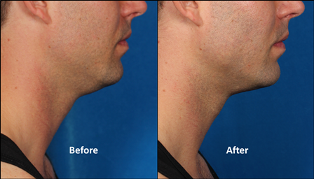 male_left side_kybella_kythera_allergan_double chin_stamford_ct_dermatologist