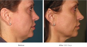 Ultherapy, female, stamfordct, noninvasive facelift, before, after