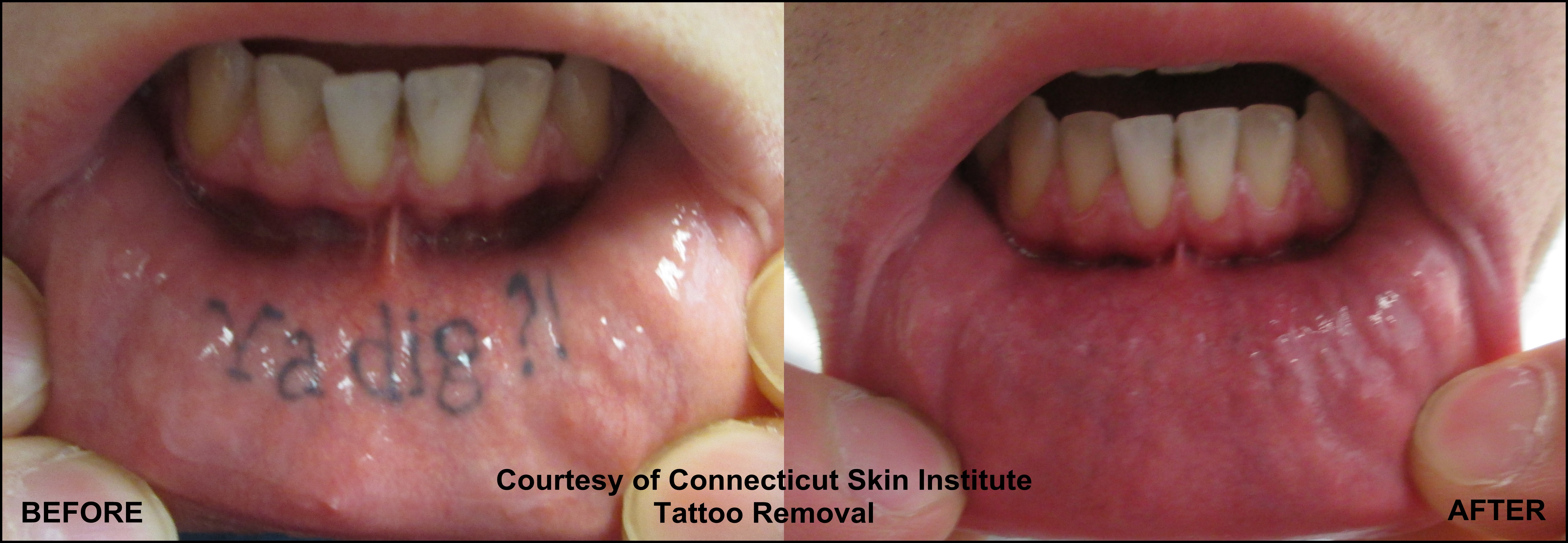 Laser Tattoo Removal Before and After - Connecticut Skin ...