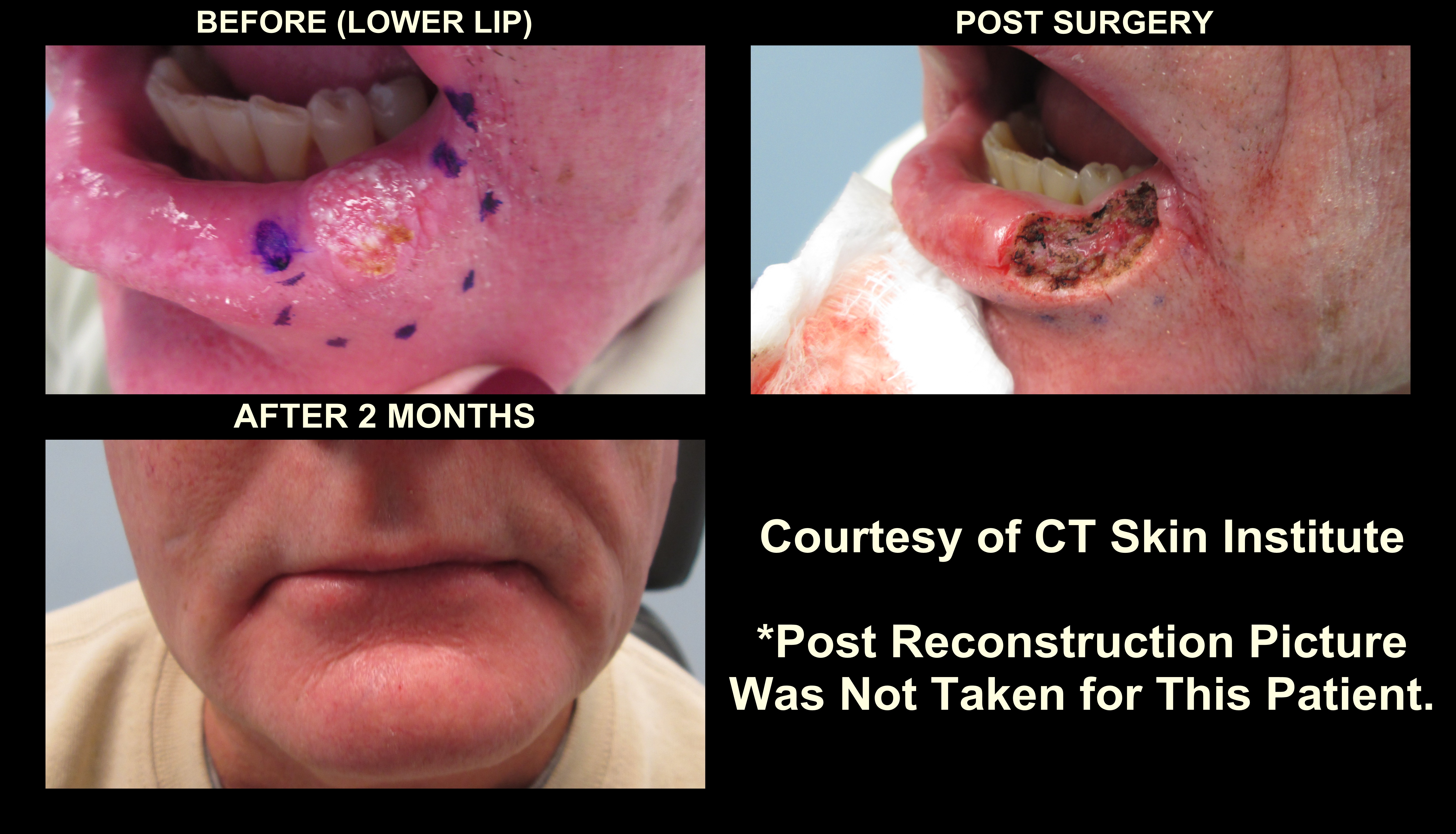 Mohs and Reconstructive Surgery - Lip - Connecticut Skin 