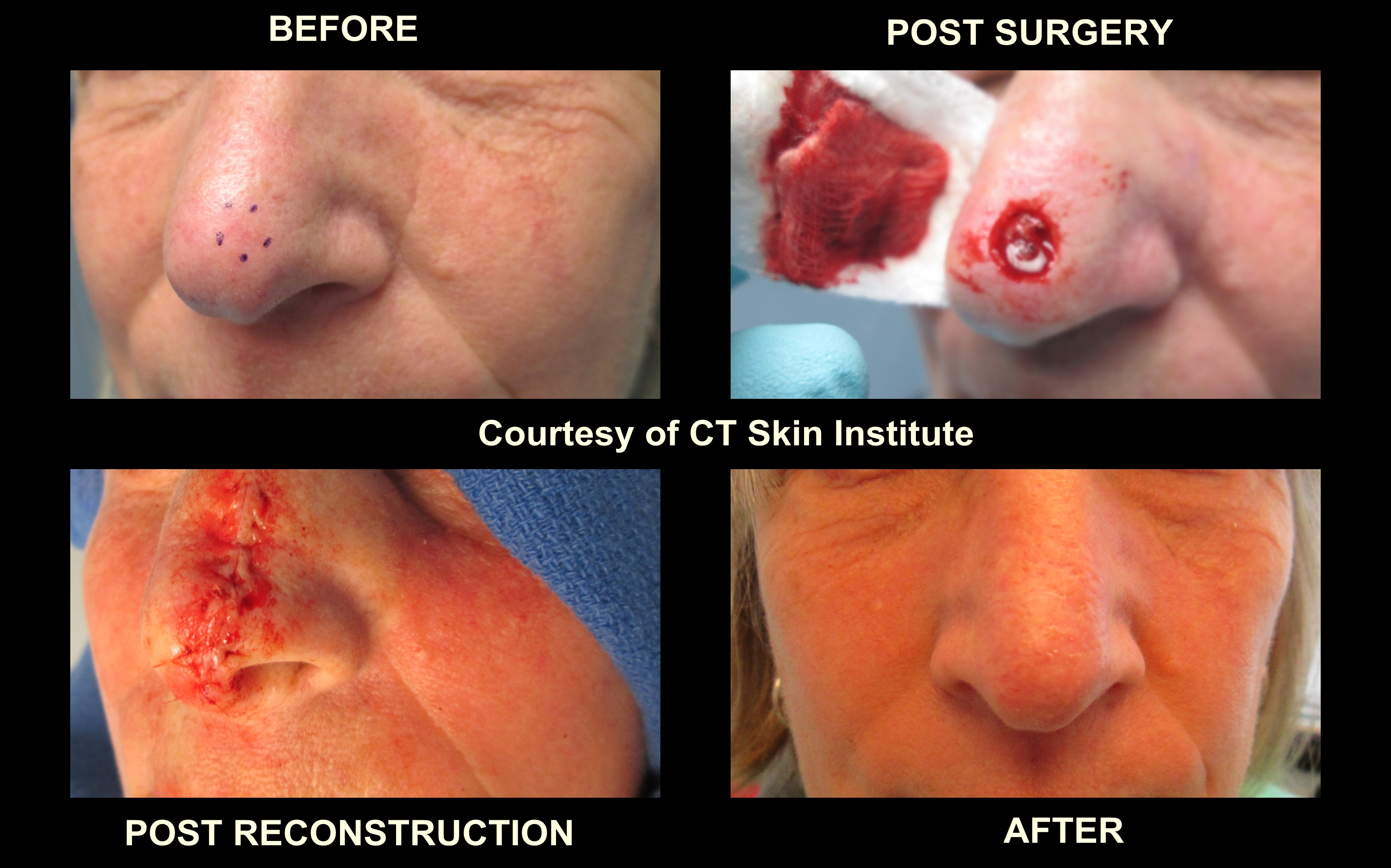 basal cell carcinoma nose before after pictures