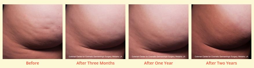 1cellfina.before.after.pictures.cellulite.stamford.ct