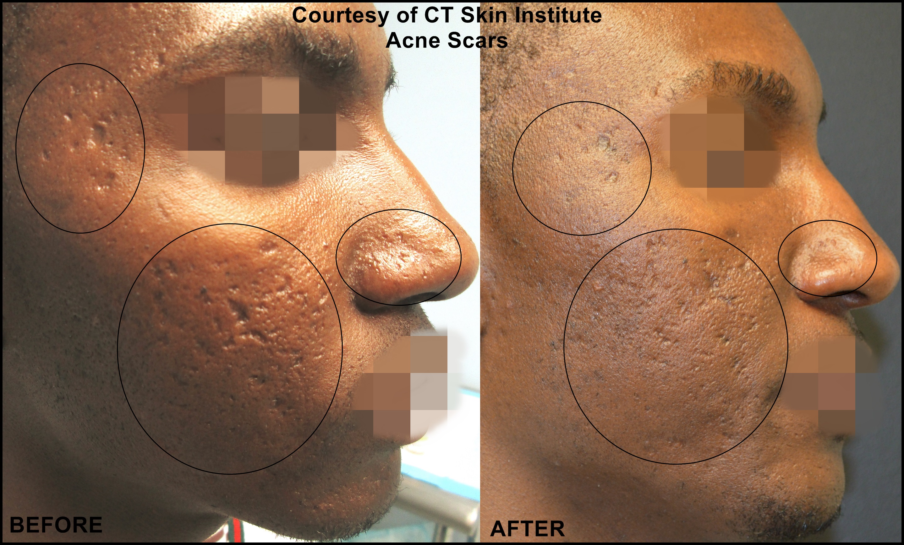 Acne Scar Treatment - Connecticut Skin Institute