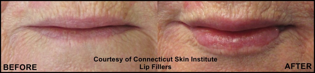 Injectables Archives - Connecticut Skin Institute