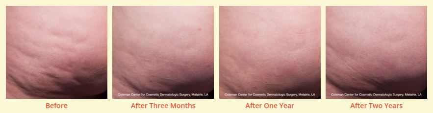 3.cellfina.before.after.pictures.cellulite.stamford.ct
