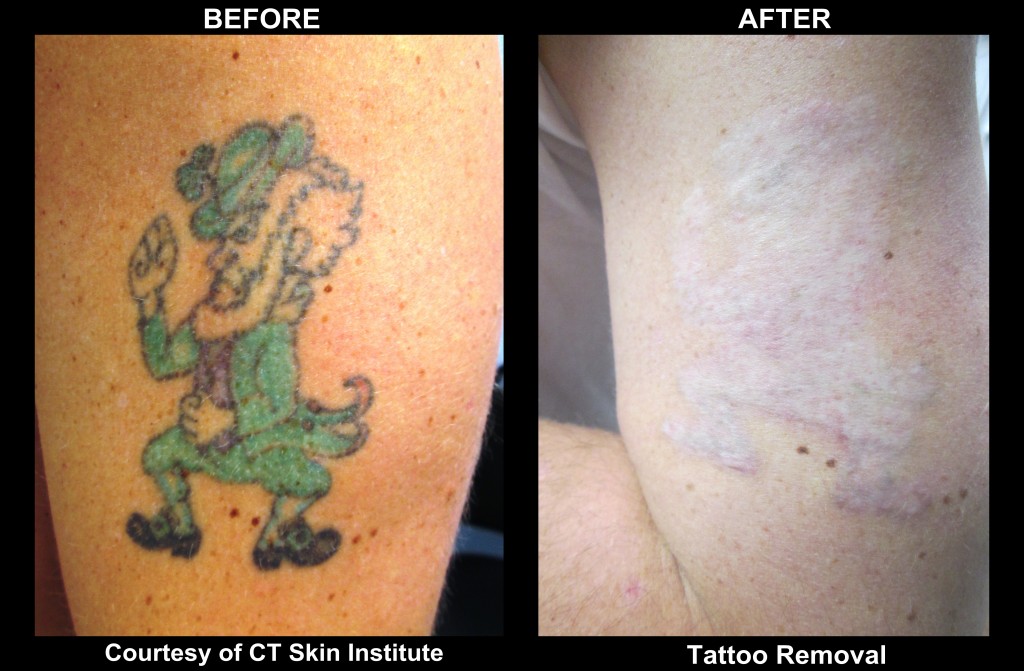 4.laser.tattoo.removal.arm.pico.picosure.qsl.stamford.ct.dermatologist