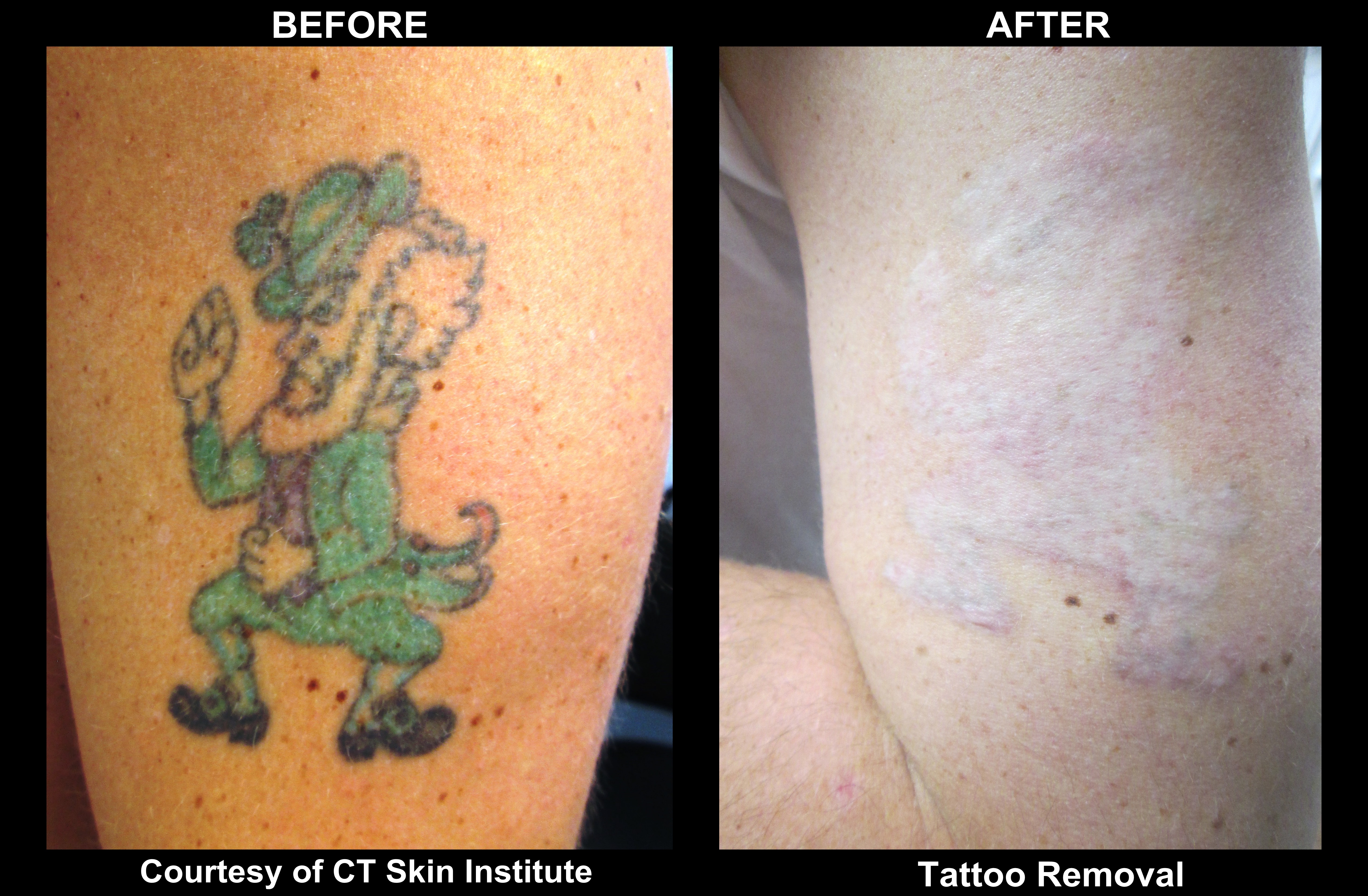 Laser Tattoo Removal Before and After - Connecticut Skin 