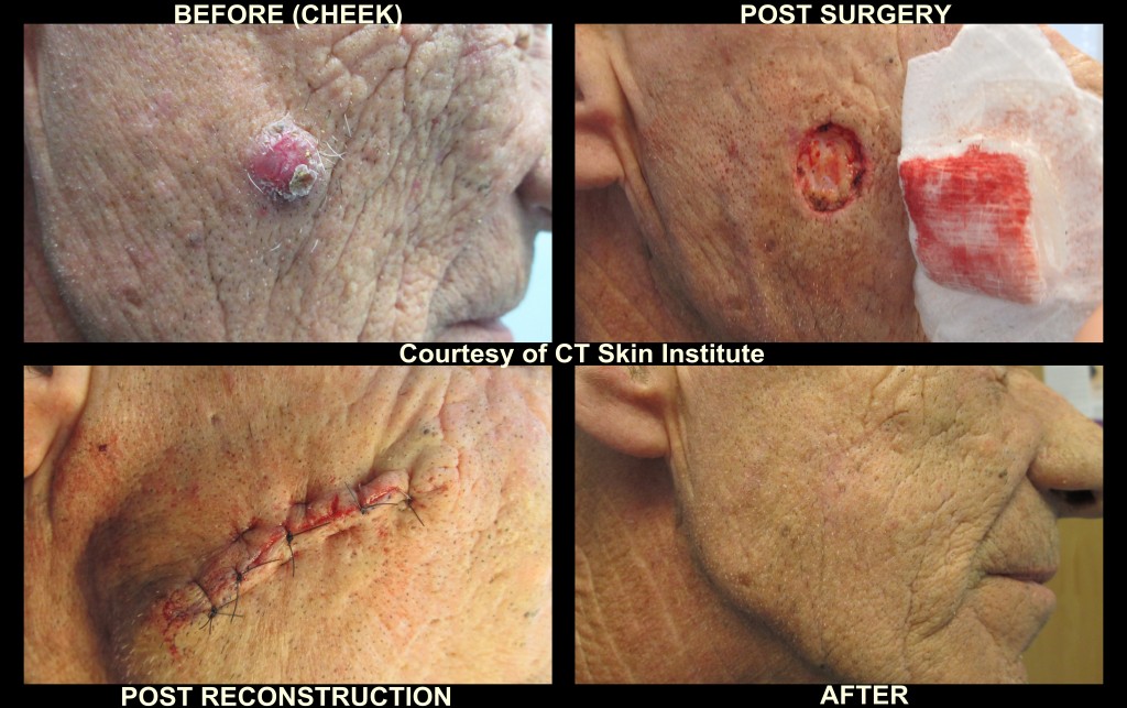 mohs archives page 2 of 3 connecticut skin institute mohs archives page 2 of 3 connecticut skin institute