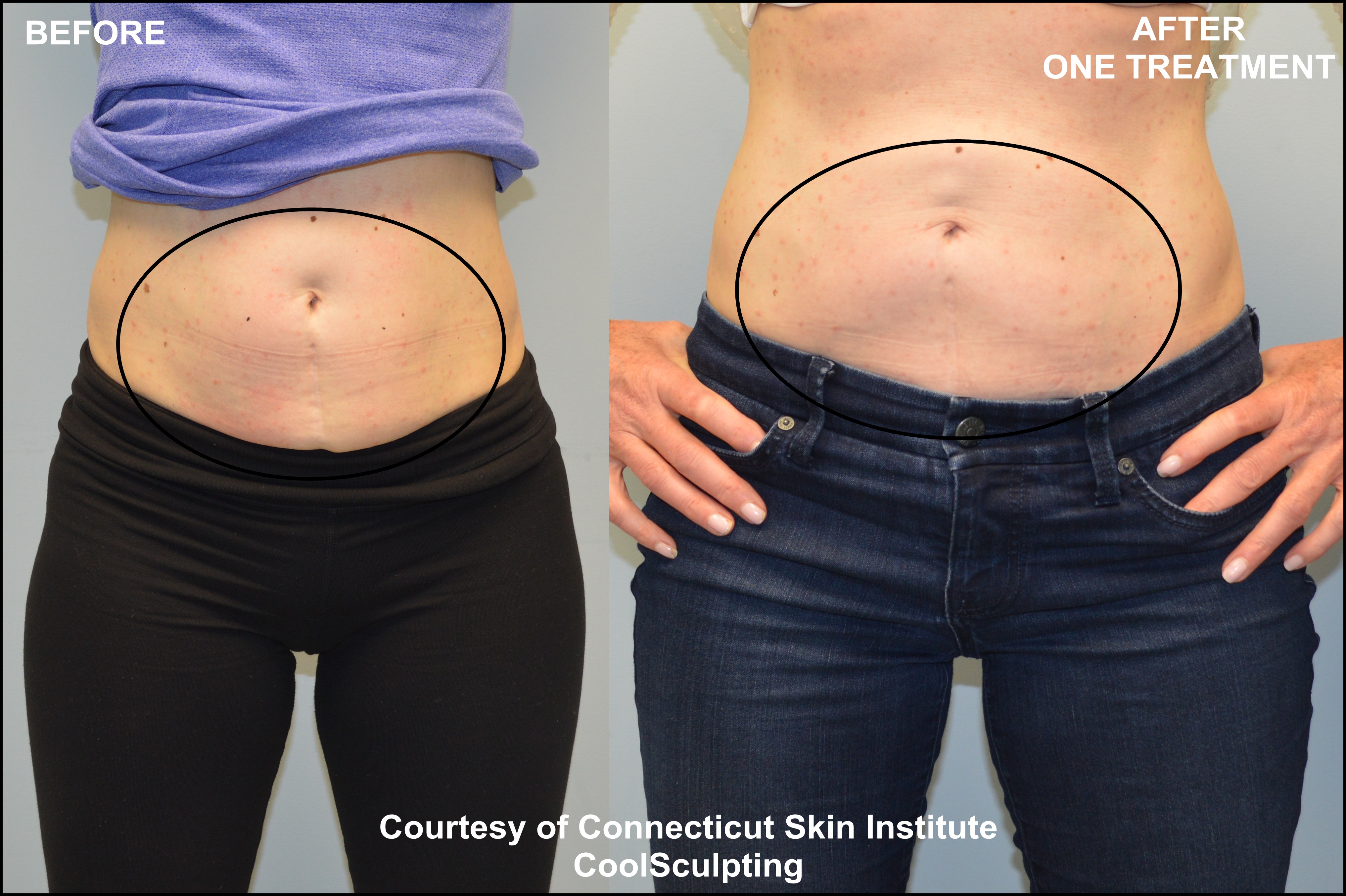 CoolSculpting Before and After Picture of Lower Abdomen - Connecticut