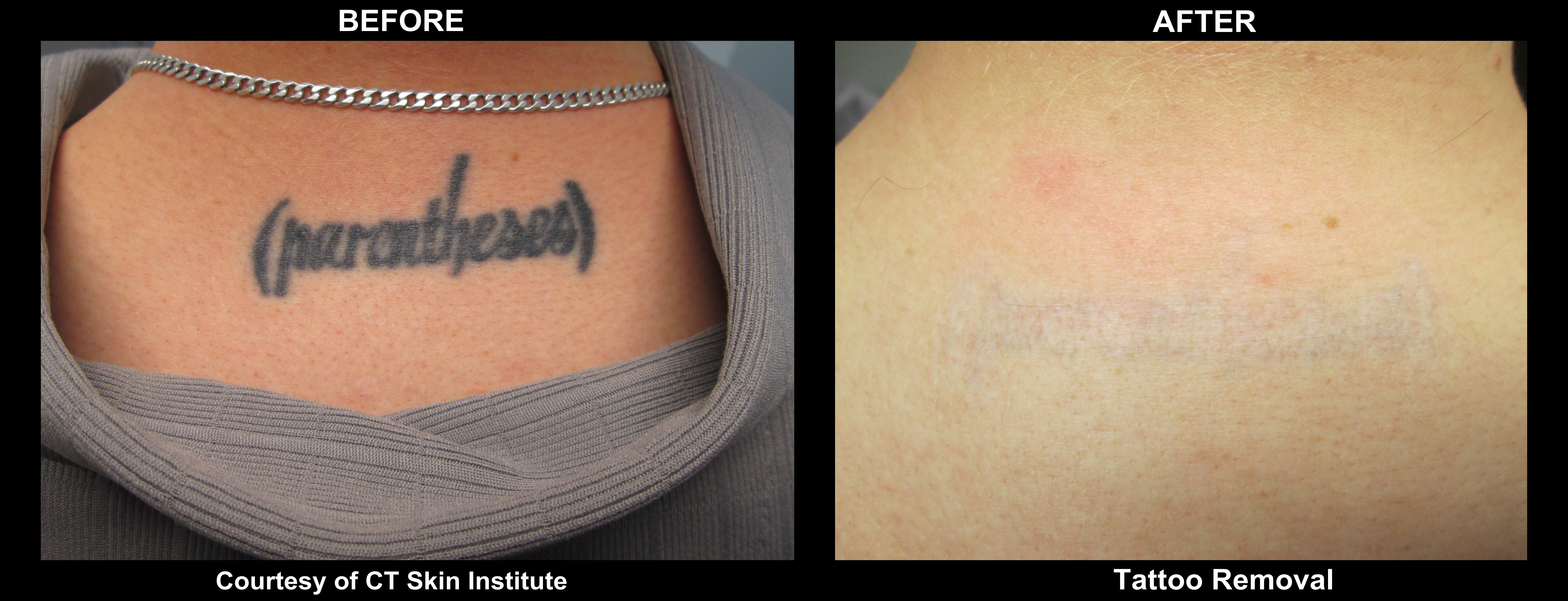 Laser Tattoo Removal Before and After Photo - Connecticut 