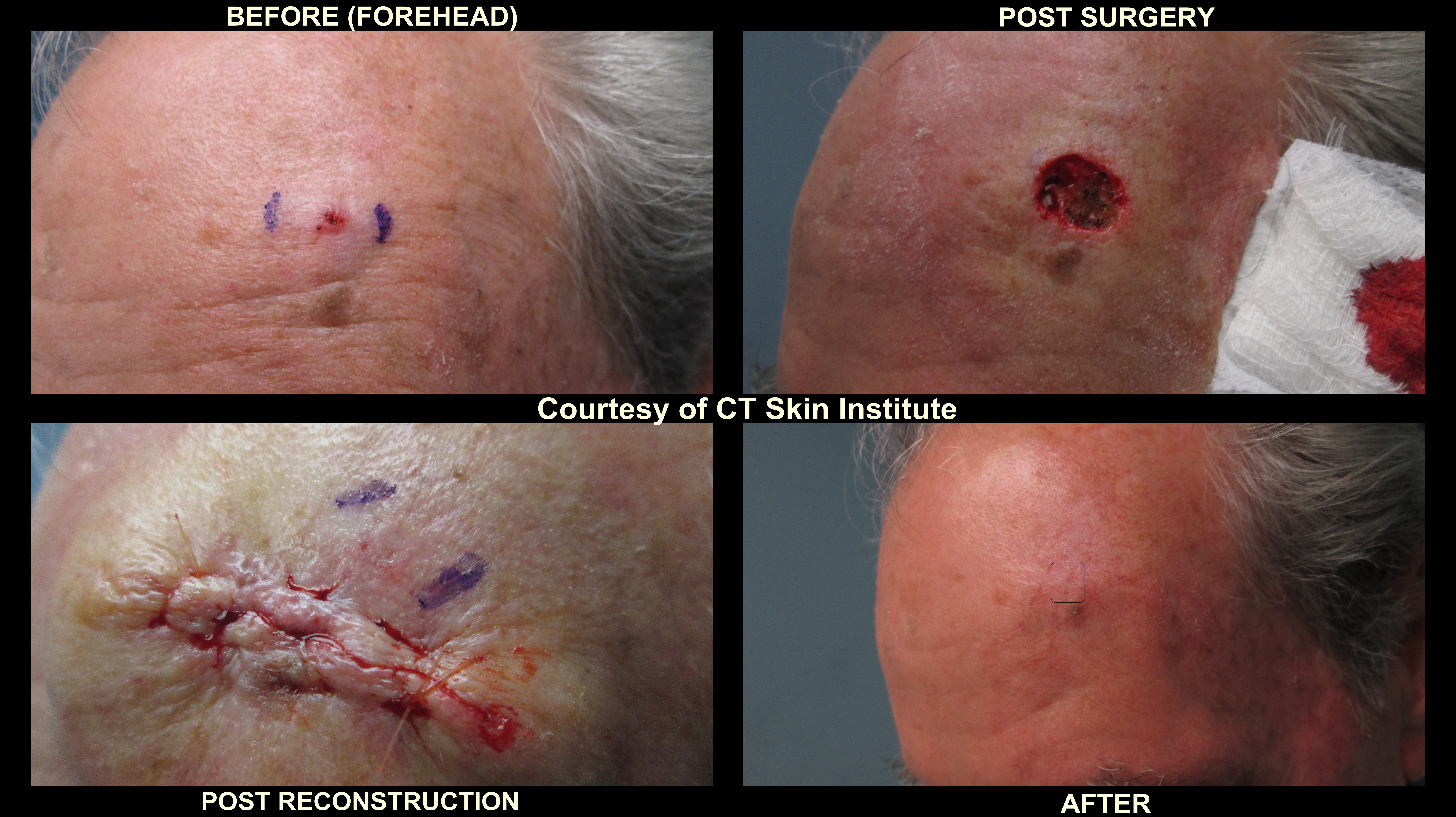 mohs and reconstructive surgery forehead connecticut mohs and reconstructive surgery forehead connecticut