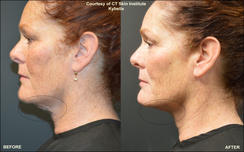 Kybella Archives - Connecticut Skin Institute