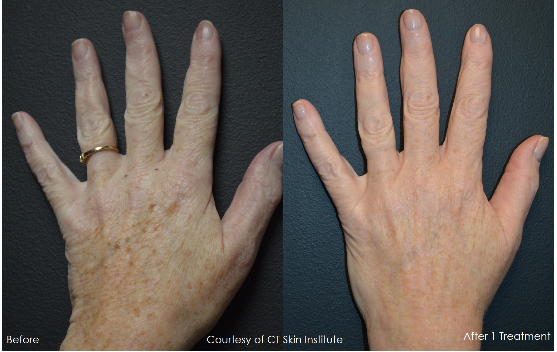 Age Spots or Brown Spots on Hands using Pico Genesis ...