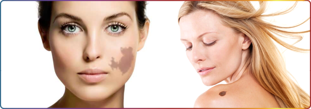 laser-birthmark-removal-remove-birthmarks-port-wine-stains