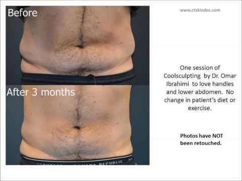 Coolsculpting: freeze fat testimonial review before and after of 50 year old male in Stamford, CT