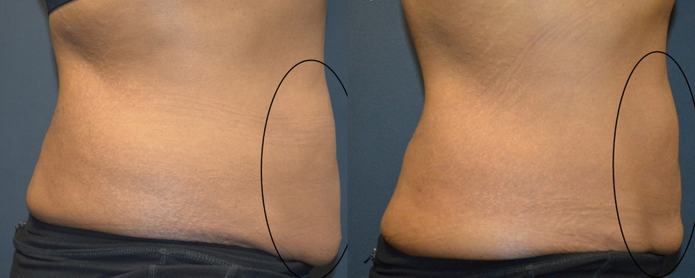 CoolSculpting: Before and After Picture of Female Abdomen