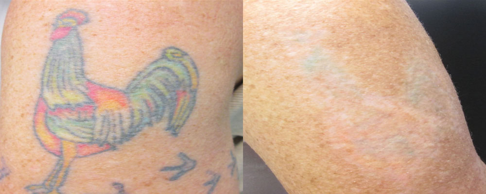 Laser Tattoo Removal Before and After Photo