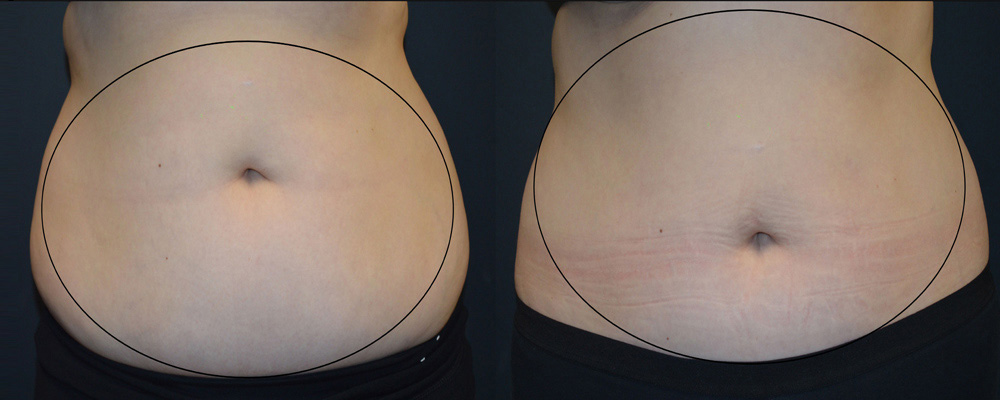 CoolSculpting: Before and After of Female Abdomen