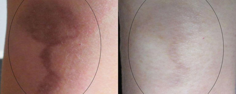 burn-scar-laser-treatment-connecticut-skin-institute