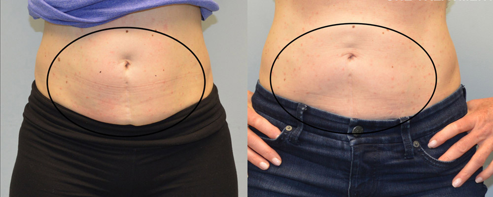 CoolSculpting Before and After Picture of Lower Abdomen