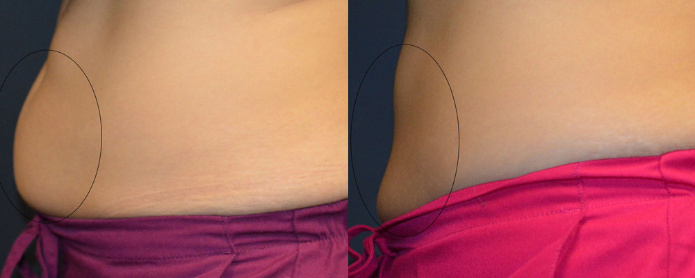 Coolsculpting: Before and After Picture of Female for Stomach Fat