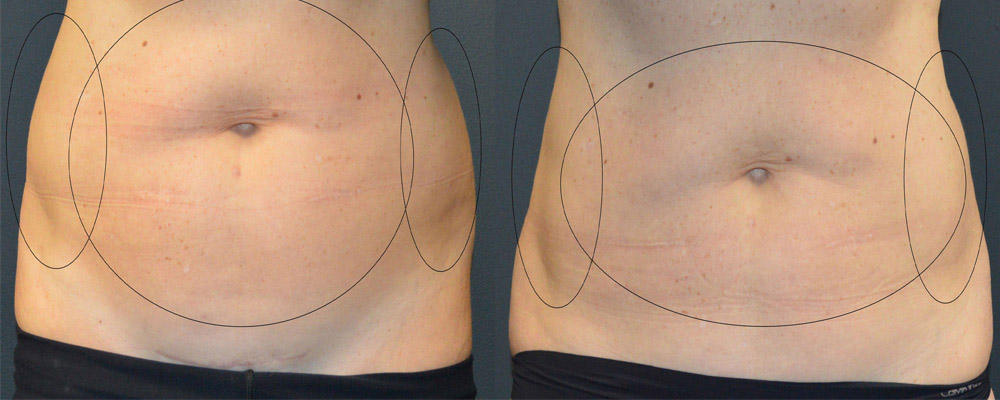 CoolSculpting Before and After Picture of Stomach and Love Handles