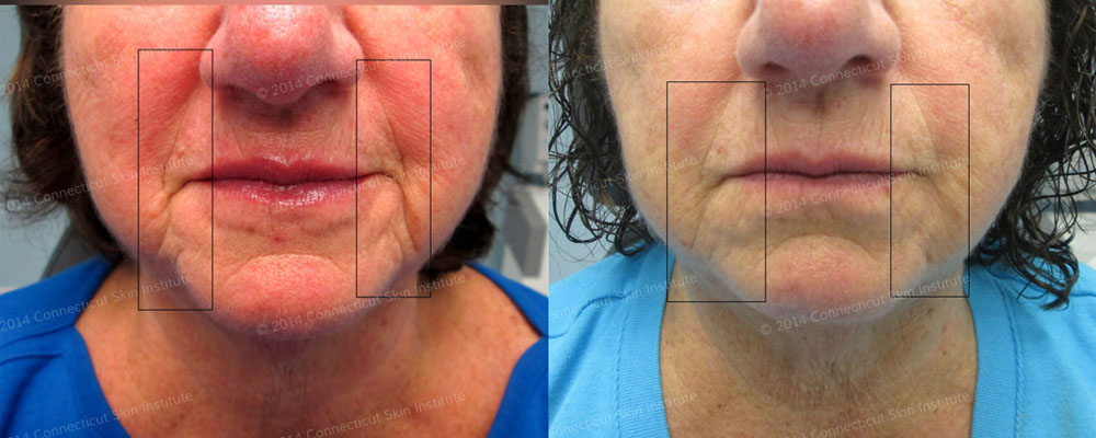 Filler injections to treat wrinkles