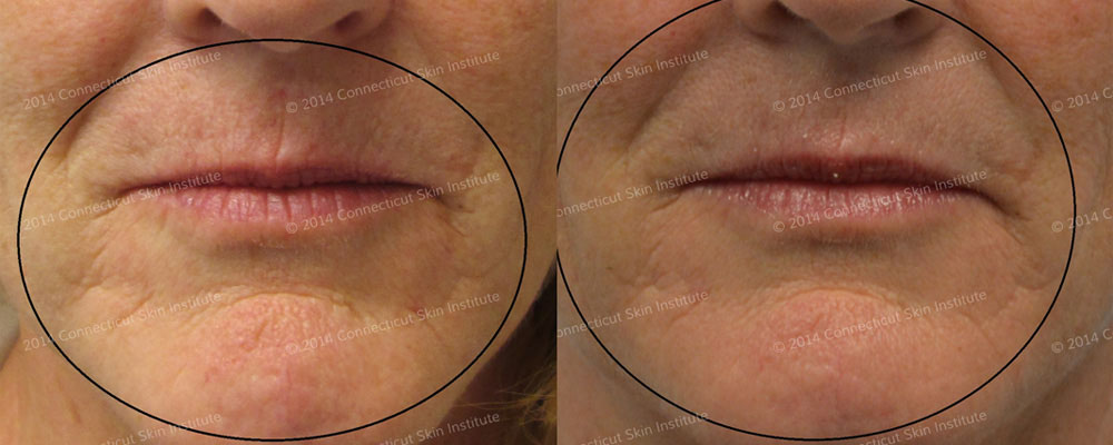 Skin tightening of wrinkles around mouth