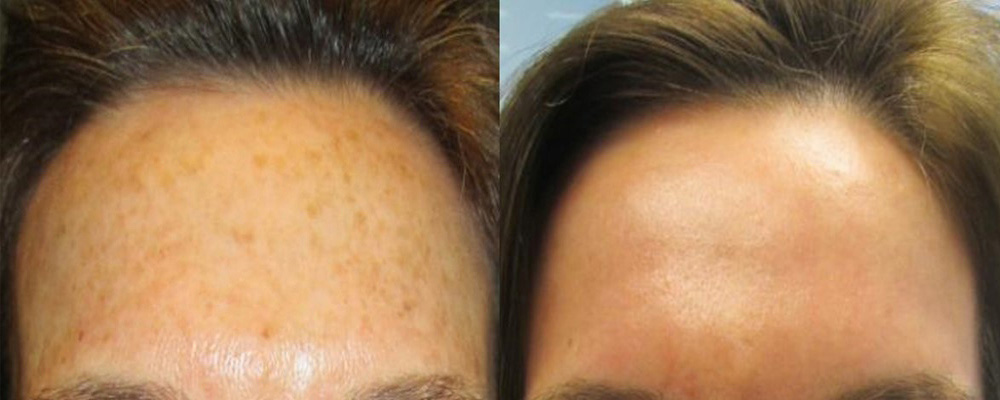 Before and After Photo after Fraxel Treatment