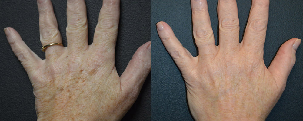 Age Spots or Brown Spots on Hands using Pico Genesis