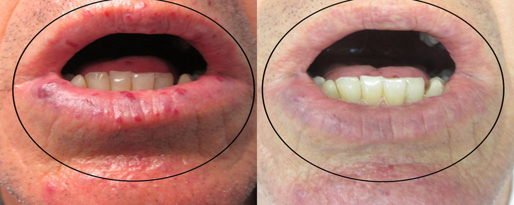 Laser Treatment to Remove Red Spots