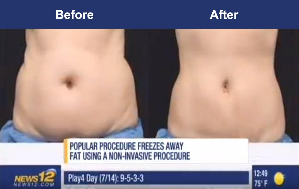 News 12: Dr. Ibrahimi explains everything you need to know about CoolSculpting to freeze fat