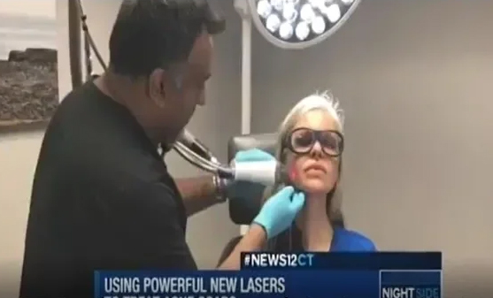 Laser Treatment for Acne Scars: Dr Omar Ibrahimi Discusses on News 12 CT